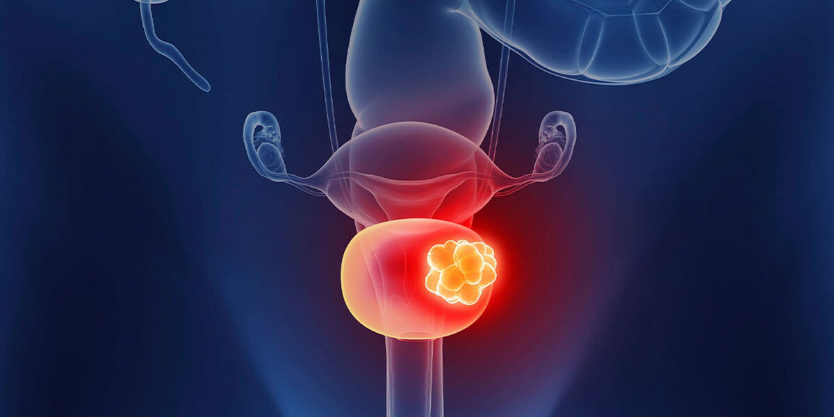 bladder cancer